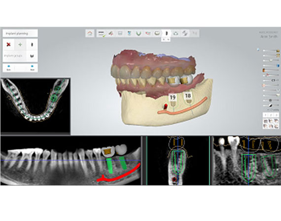 BAR IMPLANT DESIGNING