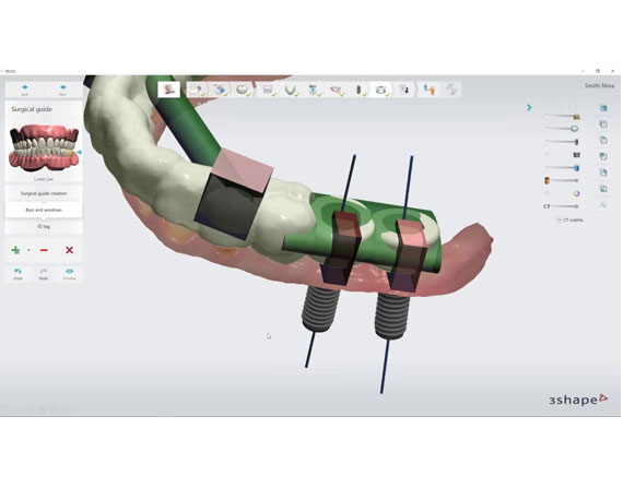 IMPLANT STUDIO DESIGNING