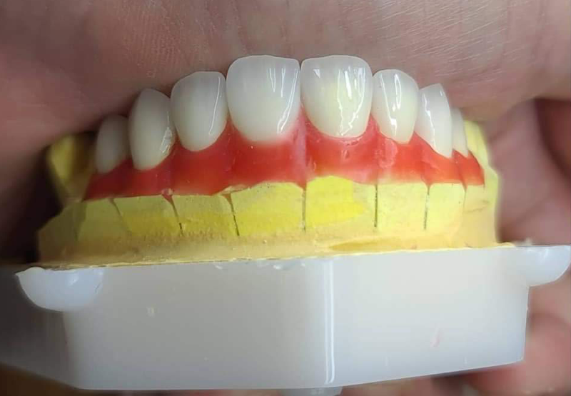 RĂNG SỨ CERAMILl