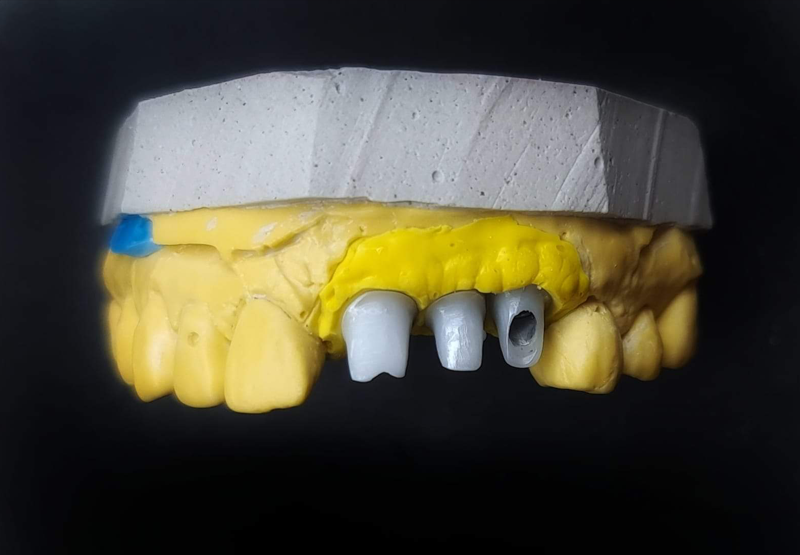 CUSTOMIZED ABUTMENT