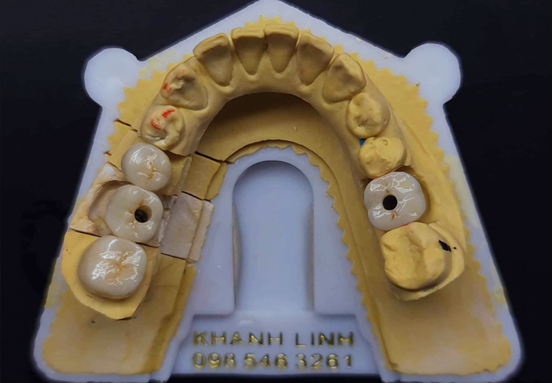 PHỤC HÌNH IMPLANT