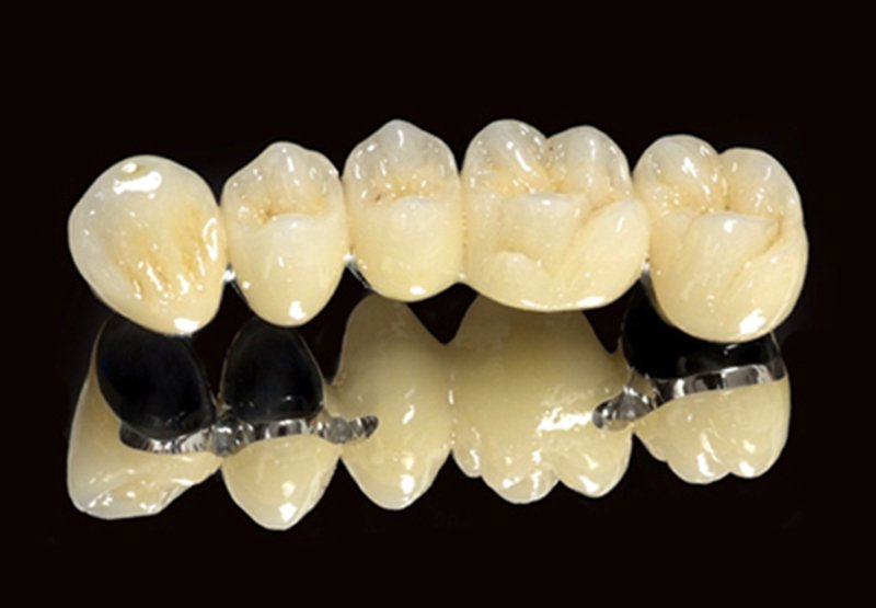 RĂNG SỨ KIM LOẠI THƯỜNG